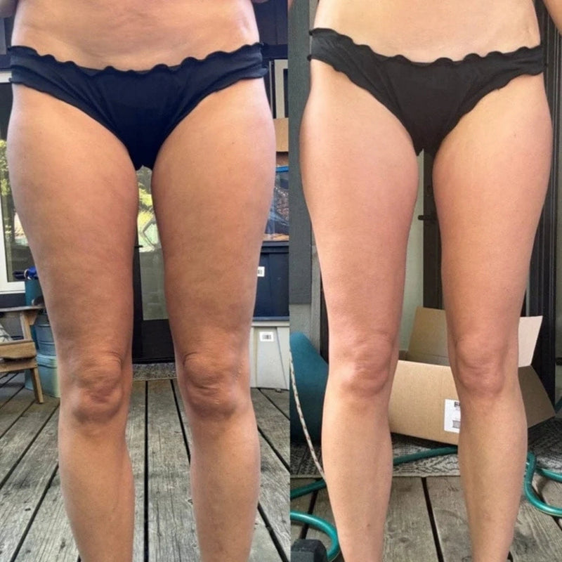 Nemeric™ - Anti-Cellulite Massager